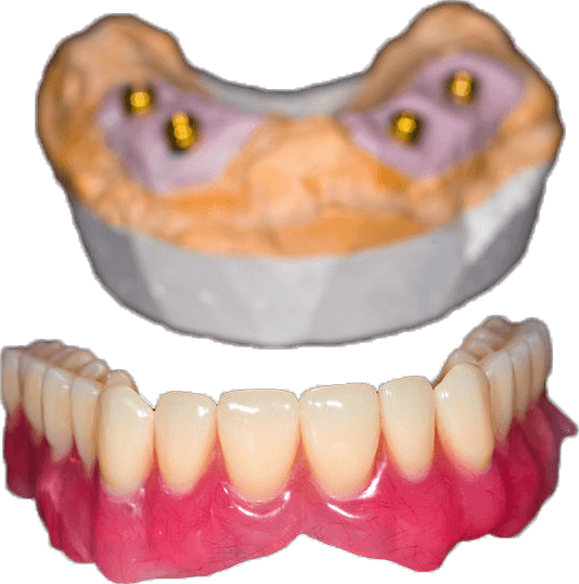 General dentistry full dentures partial dentures at Jenny Ngai, DDS Award Winning Local Edmonds Dentistry